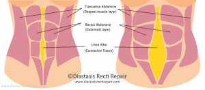 Diastasis Recti