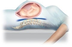 Supine Hypotensive Syndrome